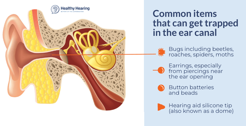 Bugs Items Trapped In Ear Hearing Aids 