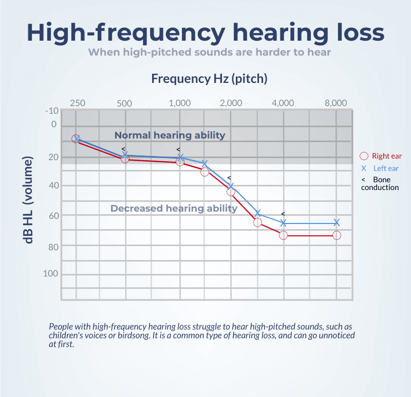 Un audiograma que muestra pérdida de audición de alta frecuencia.